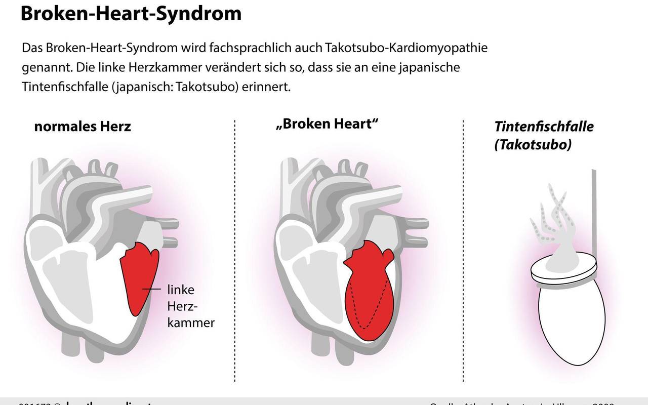 Broken-Heart-Syndrom