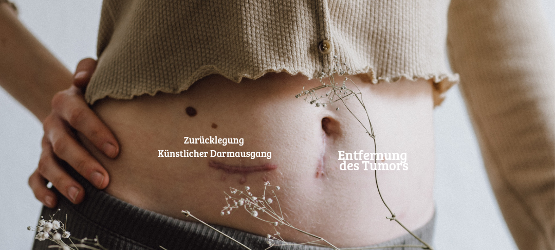 Projekt zur Krebsvorsorge