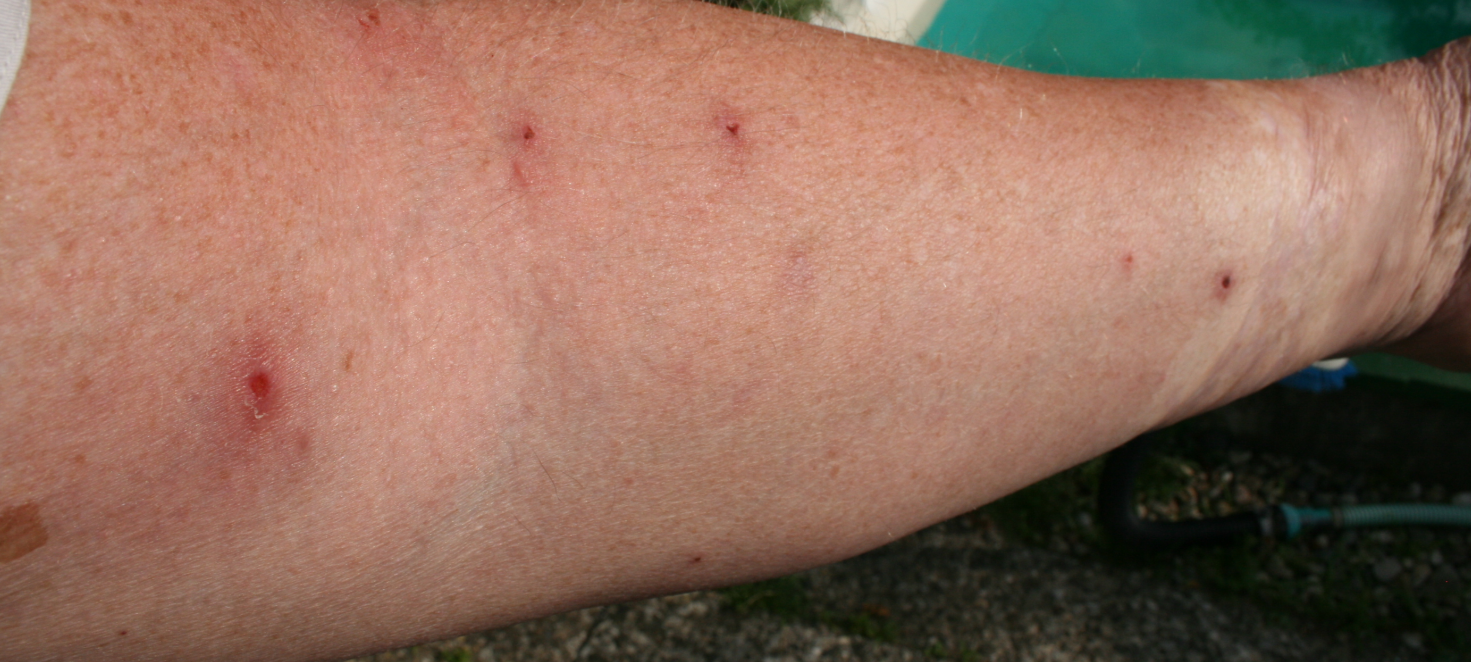 So schützt ihr euch vor der gefährlichen Raupe